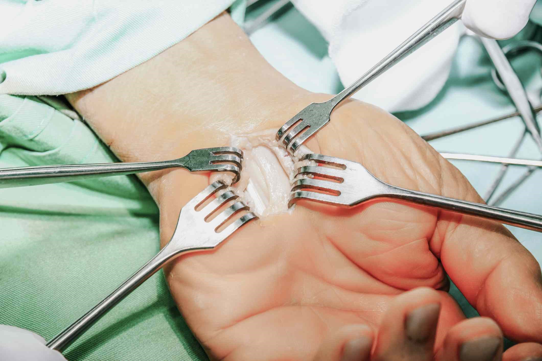 In general, carpal tunnel expansion in Turkey can be performed in two ways, as follows
