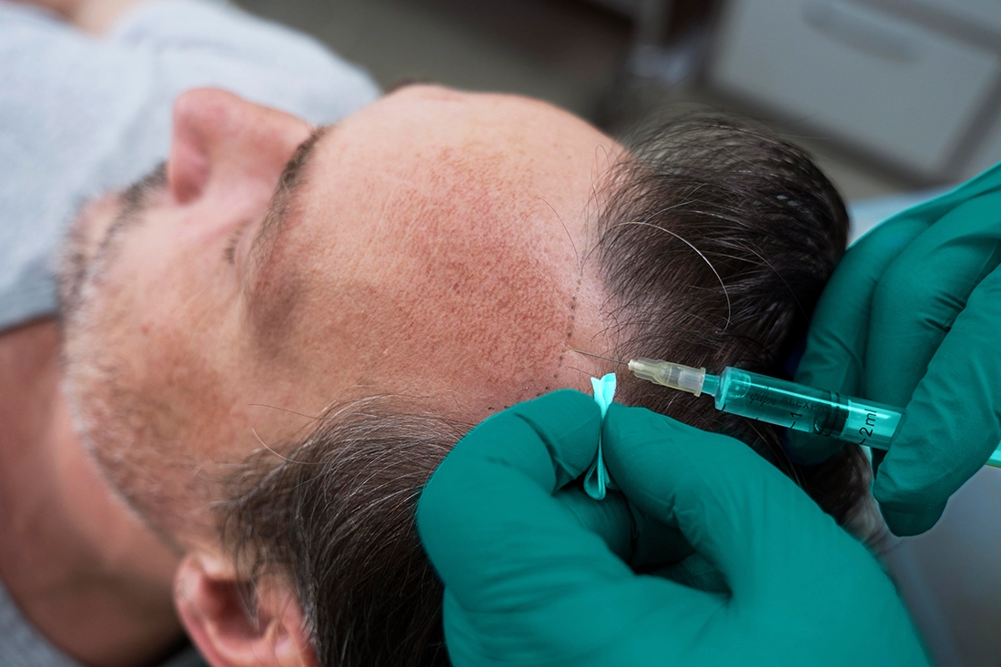 o9Medical - زراعة الشعر في تركيا