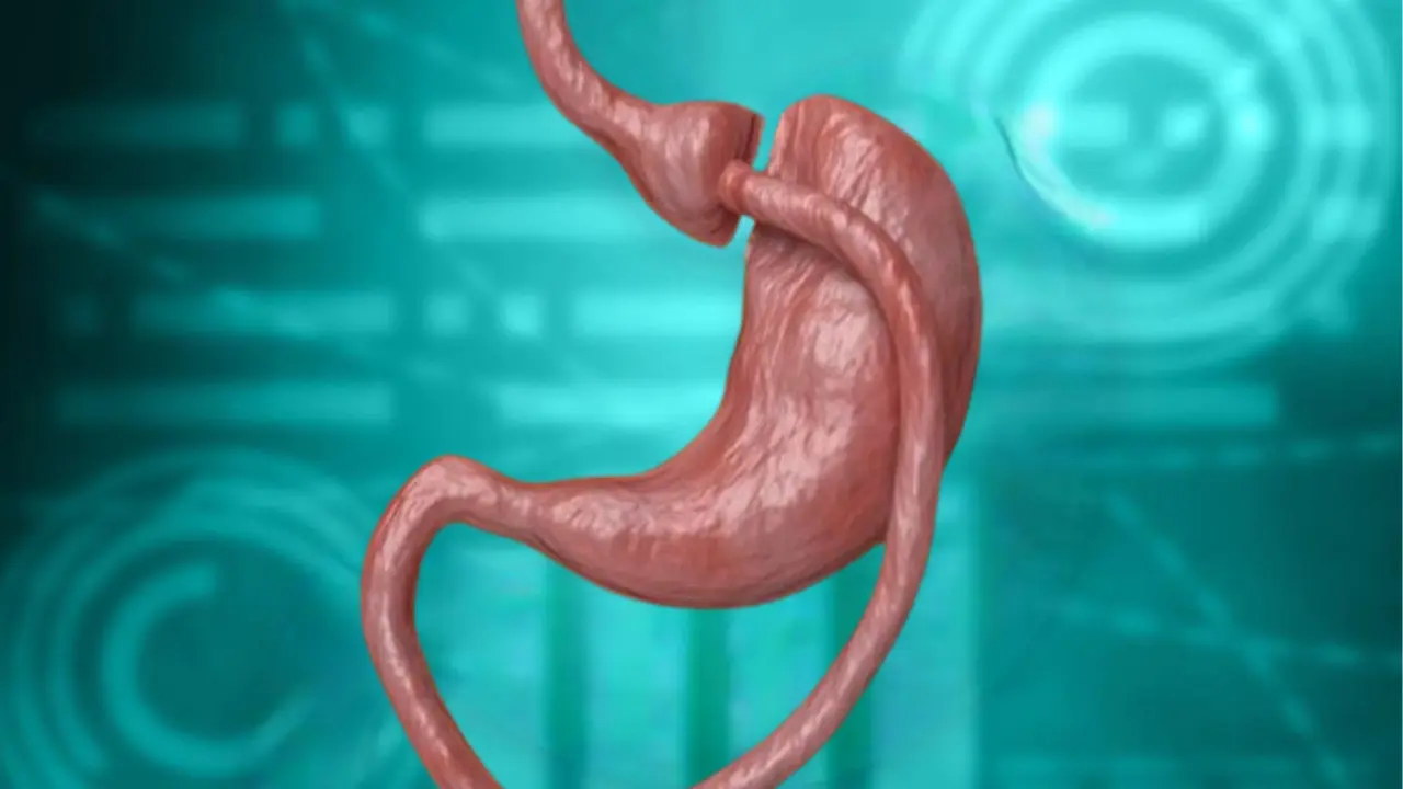 o9Medical - Gastric bypass surgery in Turkey